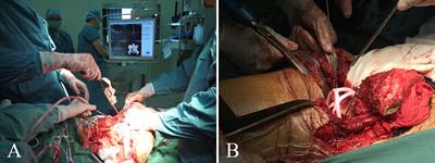 Comparison of customized 3D-printed prosthesis and screw-rod-cage system reconstruction following resection of periacetabular tumors